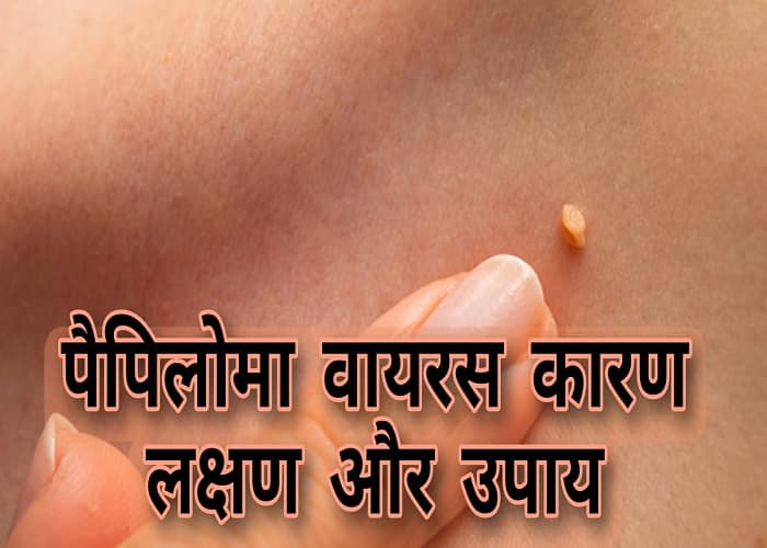 Papilloma virus causes, symptoms, and remedies in Hindi