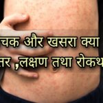 What are Chickenpox and Measles, the difference, symptoms, spread, treatment and prevention in hindi